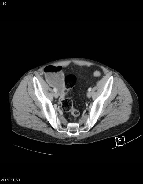 File:Boerhaave syndrome with tension pneumothorax (Radiopaedia 56794-63603 A 55).jpg
