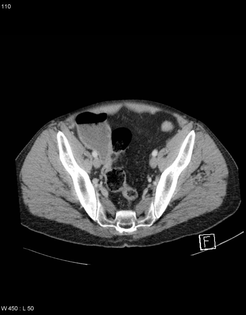Boerhaave syndrome with tension pneumothorax (Radiopaedia 56794-63603 A 55).jpg