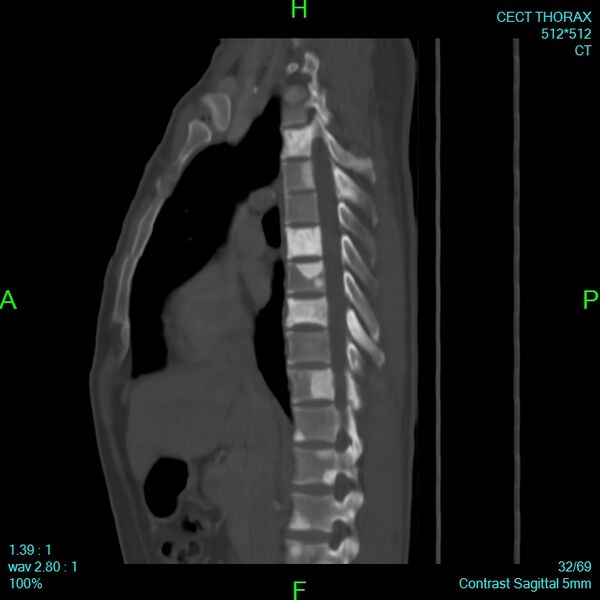 File:Bone metastases from lung carcinoma (Radiopaedia 54703-60937 Sagittal bone window 32).jpg