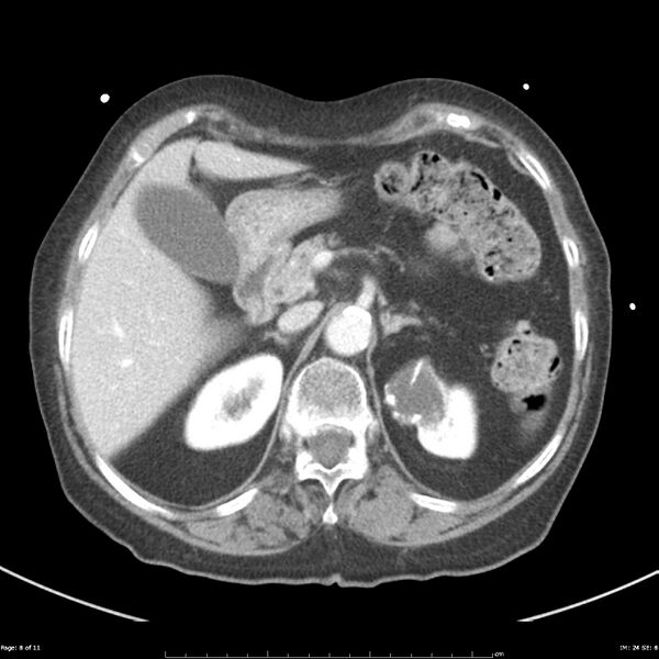 File:Bosniak renal cyst - type IIF (Radiopaedia 23385-23450 A 8).jpg