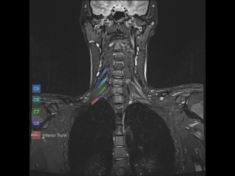 File:Brachial plexus anatomy (Radiopaedia 64414-73226 Coronal STIR 8).jpeg