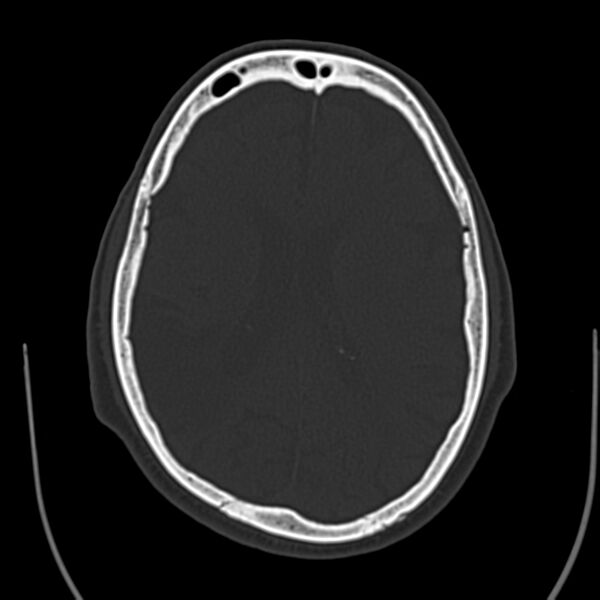 File:Brain Pantopaque remnants (Radiopaedia 78403-91048 Axial bone window 43).jpg