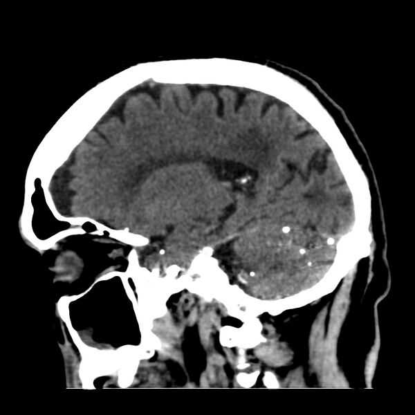 File:Brain Pantopaque remnants (Radiopaedia 78403-91048 C 21).jpg