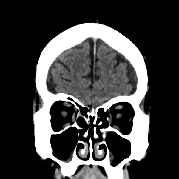 File:Brain Pantopaque remnants (Radiopaedia 78403-91048 Coronal non-contrast 15).jpg