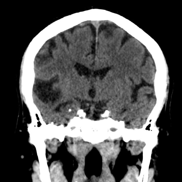 File:Brain Pantopaque remnants (Radiopaedia 78403-91048 Coronal non-contrast 35).jpg