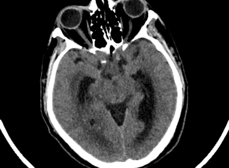 File:Brain abscess complicated by intraventricular rupture and ventriculitis (Radiopaedia 82434-96575 Axial non-contrast 22).jpg