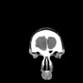 Brain death (Radiopaedia 78597-91360 Coronal non-contrast 8).jpg