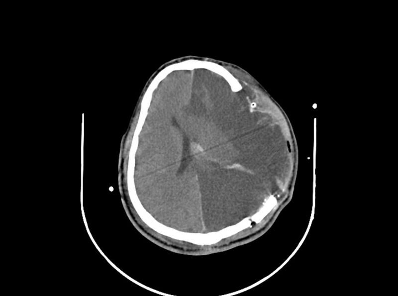 File:Brain injury by firearm projectile (Radiopaedia 82068-96087 B 123).jpg