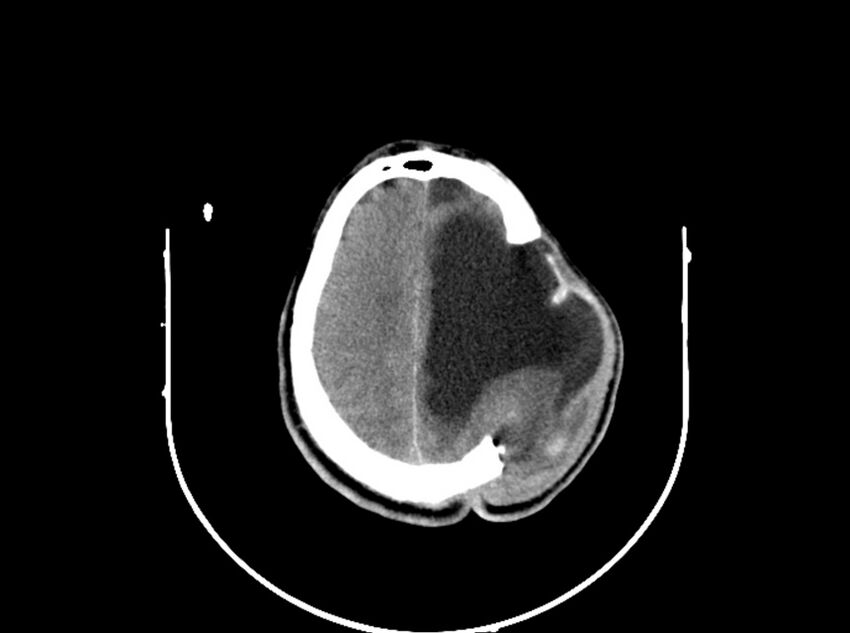 Brain injury by firearm projectile (Radiopaedia 82068-96088 A 165).jpg