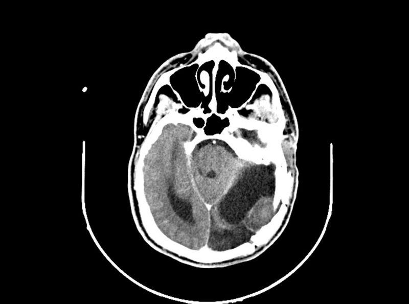File:Brain injury by firearm projectile (Radiopaedia 82068-96088 B 100).jpg