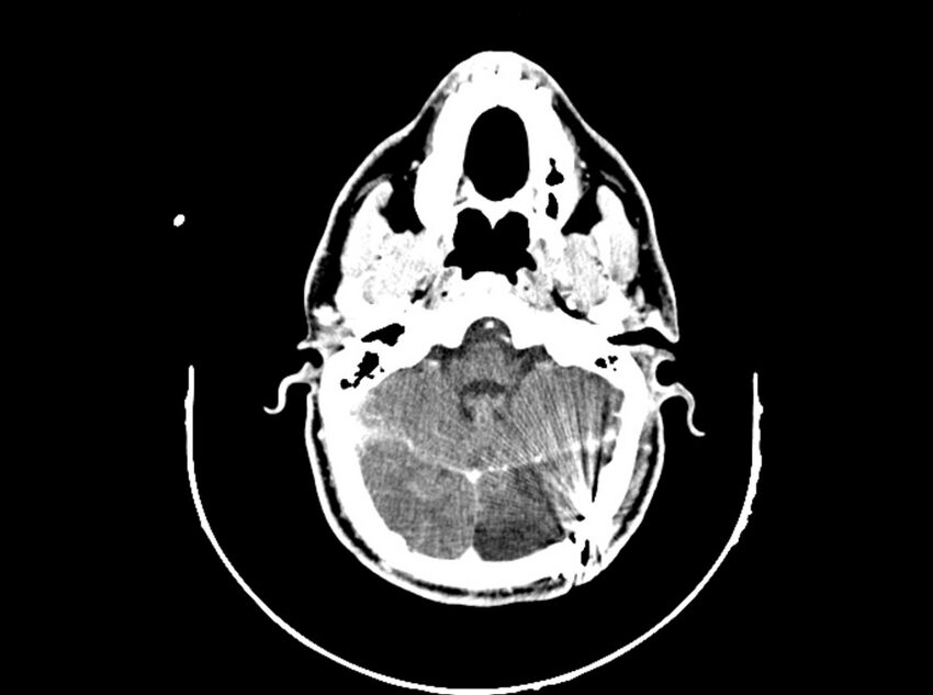 Brain injury by firearm projectile (Radiopaedia 82068-96088 B 84).jpg