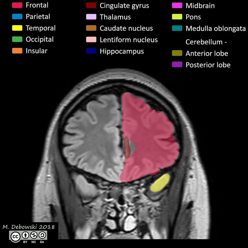 Brain lobes - annotated MRI (Radiopaedia 61691-69700 Coronal 17).JPG