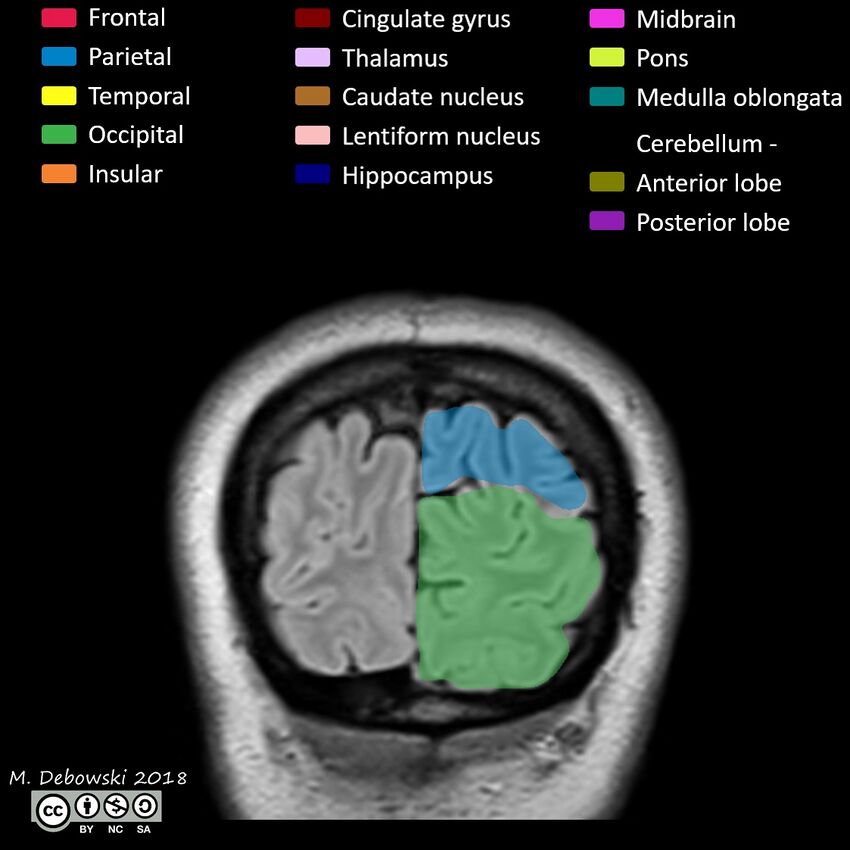 Brain lobes - annotated MRI (Radiopaedia 61691-69700 Coronal 68).JPG