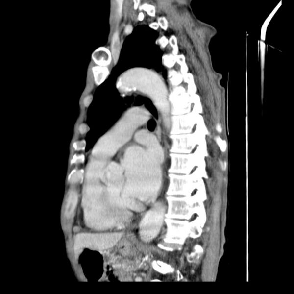 File:Brain metastases from lung cancer (Radiopaedia 27849-28093 F 46).jpg