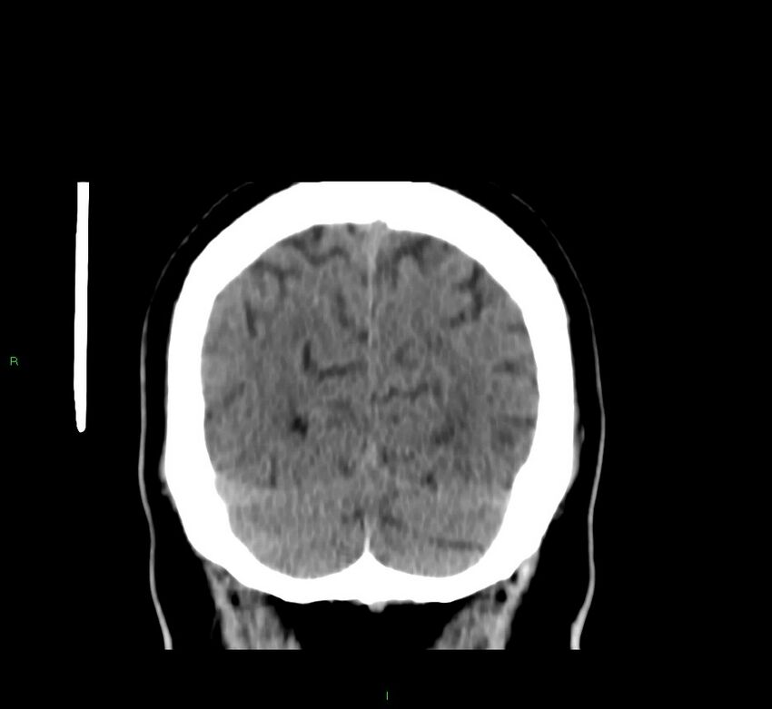 Brainstem hemorrhage (Radiopaedia 58794-66028 Coronal non-contrast 14).jpg