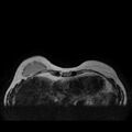 Breast implants - MRI (Radiopaedia 26864-27035 Axial T2 7).jpg