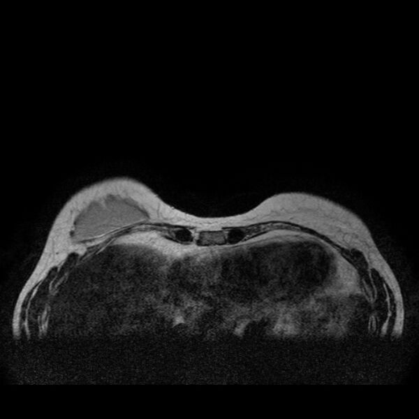 File:Breast implants - MRI (Radiopaedia 26864-27035 Axial T2 7).jpg