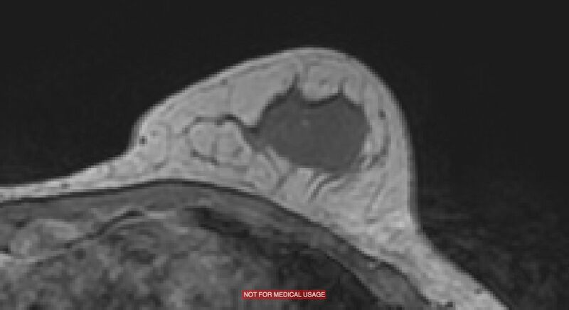 File:Breast lymphoma (MRI) (Radiopaedia 34999-36498 Axial T1 18).jpg