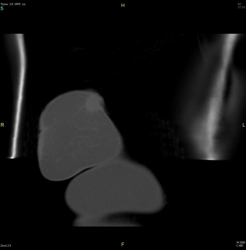 Breast primary with lung and bone metastases (Radiopaedia 40620-43228 bone window 5).jpg