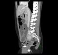 Broad ligament hernia (Radiopaedia 63260-71832 C 23).jpg