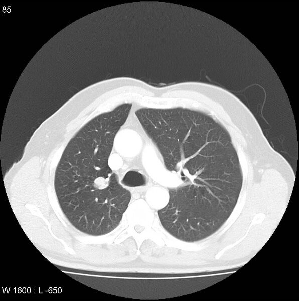 File:Bronchial carcinoid tumor with right lower lobe collapse (Radiopaedia 29060-29422 B 23).jpg