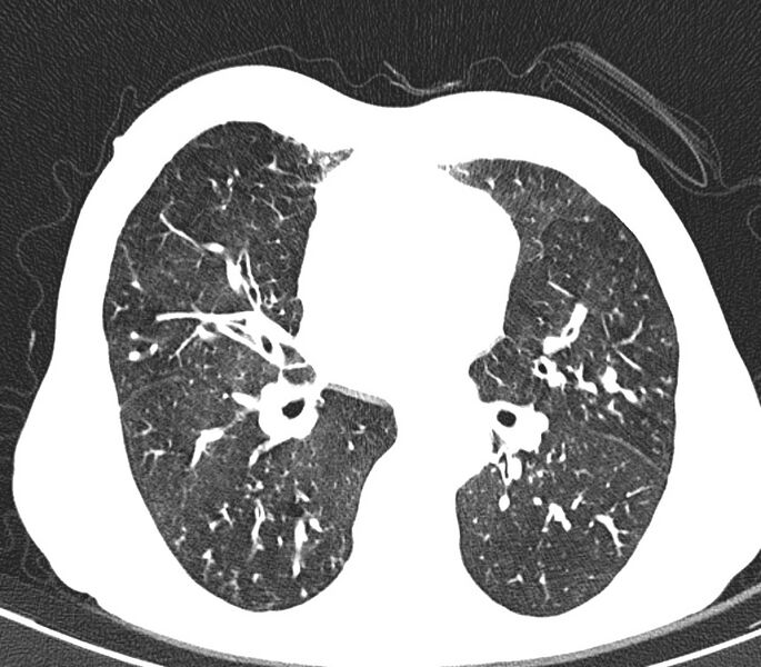File:Bronchiolitis (Radiopaedia 24616-24887 Axial lung window 30).jpg