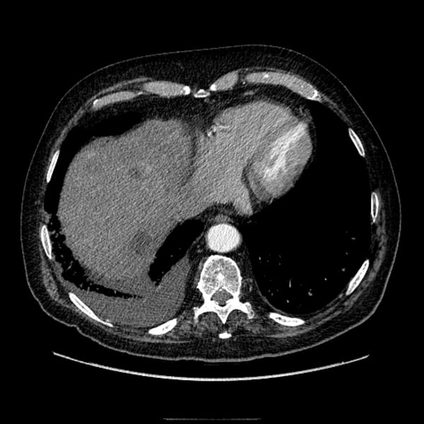 File:Bronchogenic adenocarcinoma and pulmonary embolism (Radiopaedia 9097-9806 D 47).jpg
