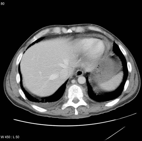 File:Bronchogenic carcinoma (Radiopaedia 8857-9645 A 14).jpg