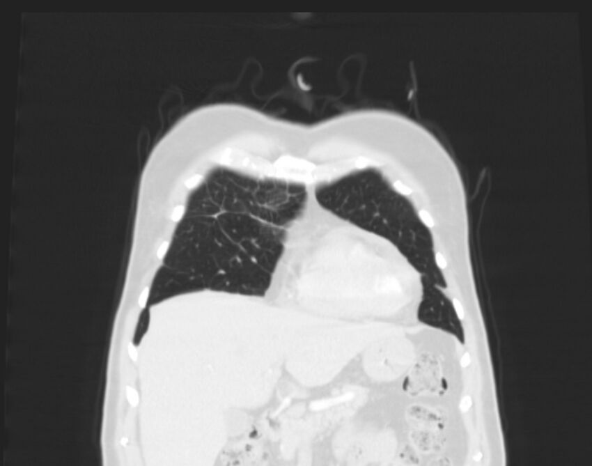 Bronchogenic carcinoma with lymphangitic spread (Radiopaedia 29002-29357 Coronal lung window 9).jpg