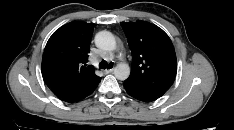 File:Bronchogenic carcinoma with superior vena cava syndrome (Radiopaedia 36497-38054 Axial C+ delayed 35).jpg