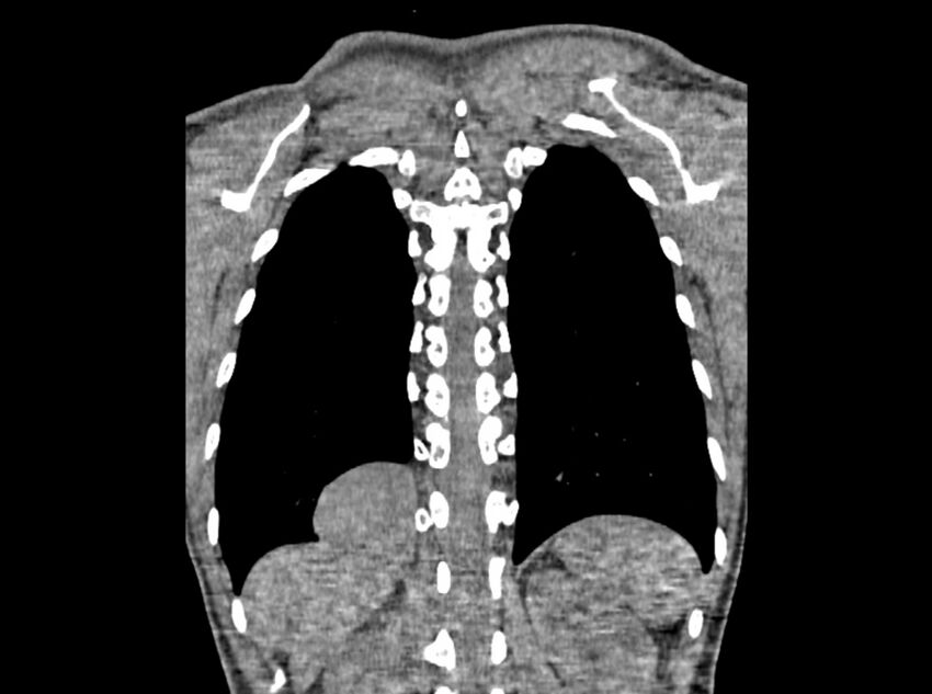 Bronchogenic cyst (Radiopaedia 80273-93615 D 116).jpg