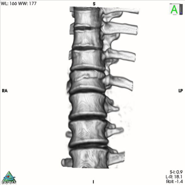 File:Bulging of paraspinal line in traumatic thoracal spinal compression fracture (Radiopaedia 29221-35872 3D VR 13).jpg