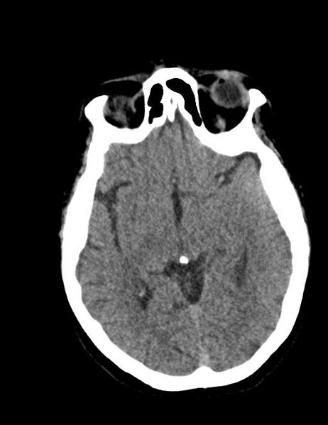 File:Burnt-out meningioma (Radiopaedia 51557-57337 Axial non-contrast 19).jpg