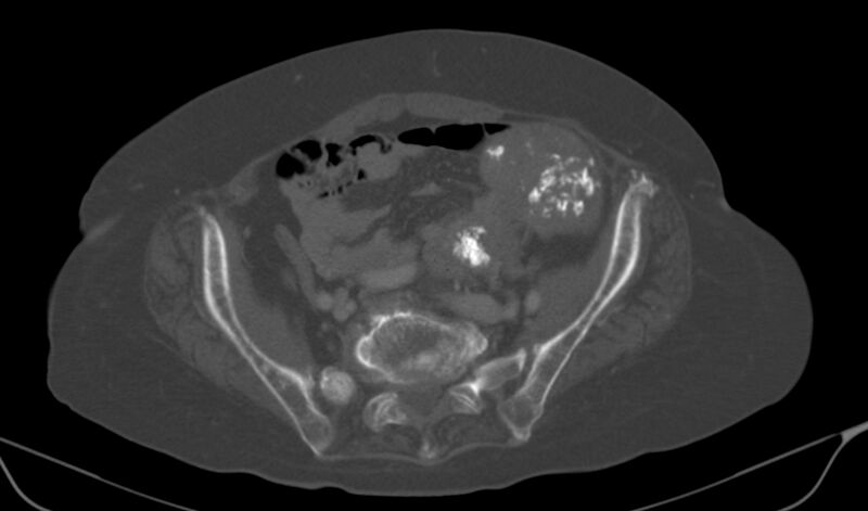 File:Calcified fibroids (Radiopaedia 20306-20228 Axial bone window 11).jpg