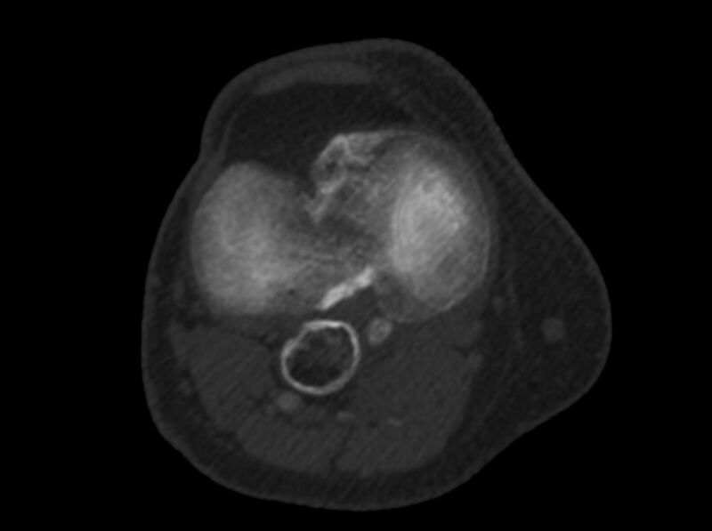 File:Calcified hematoma - popliteal fossa (Radiopaedia 63938-72763 C 31).jpg