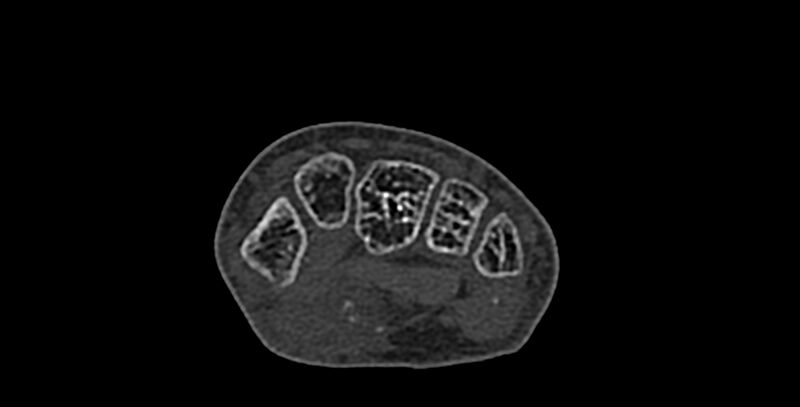 File:Calcifying aponeurotic fibroma (Radiopaedia 88423-105064 Axial bone window 86).jpg