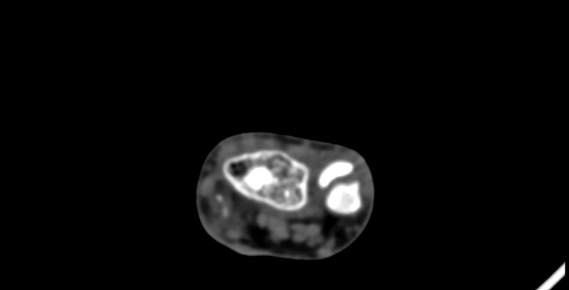 File:Calcifying aponeurotic fibroma (Radiopaedia 88423-105064 B 34).jpg