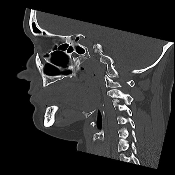 File:Canal up mastoidectomy (Radiopaedia 78108-90638 Sagittal bone window 28).jpg