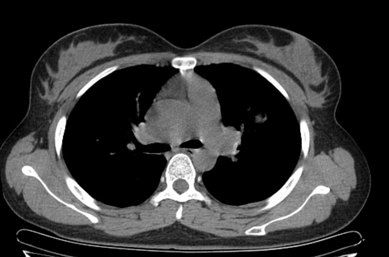 File:Cannonball metastases - uterine choriocarcinoma (Radiopaedia 70137-80173 Axial non-contrast 41).jpg