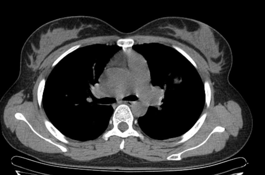 Cannonball metastases - uterine choriocarcinoma (Radiopaedia 70137-80173 Axial non-contrast 41).jpg