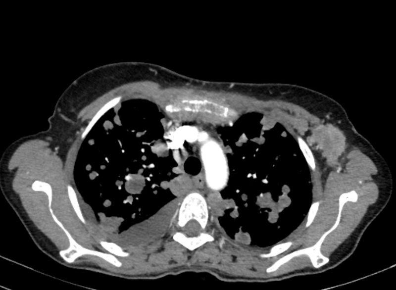 File:Cannonball metastases from breast cancer (Radiopaedia 91024-108569 A 35).jpg