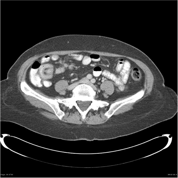 File:Carcinoid tumor of the ileum with metastasis to orbit (Radiopaedia 28165-28425 A 16).jpg