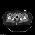 Carcinoma cervix- brachytherapy applicator (Radiopaedia 33135-34173 Axial non-contrast 48).jpg