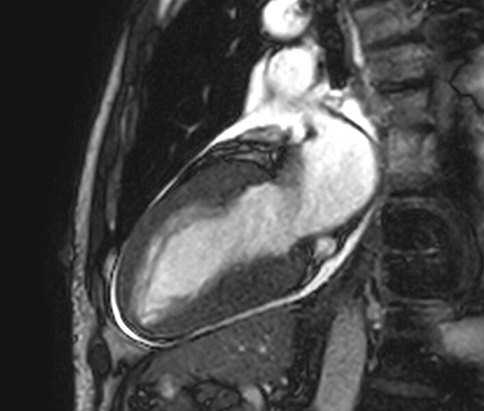 File:Cardiac amyloidosis (Radiopaedia 39736-42124 B 2).jpg