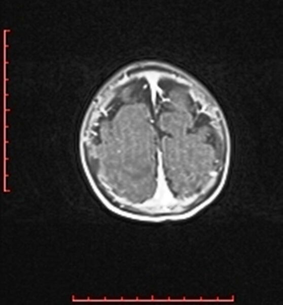 File:Cardiac rhabdomyoma - tuberous sclerosis (Radiopaedia 70089-80114 Axial T1 C+ fat sat 98).jpg