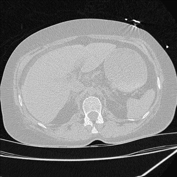 File:Cardiogenic pulmonary edema (Radiopaedia 29213-29609 Axial lung window 112).jpg