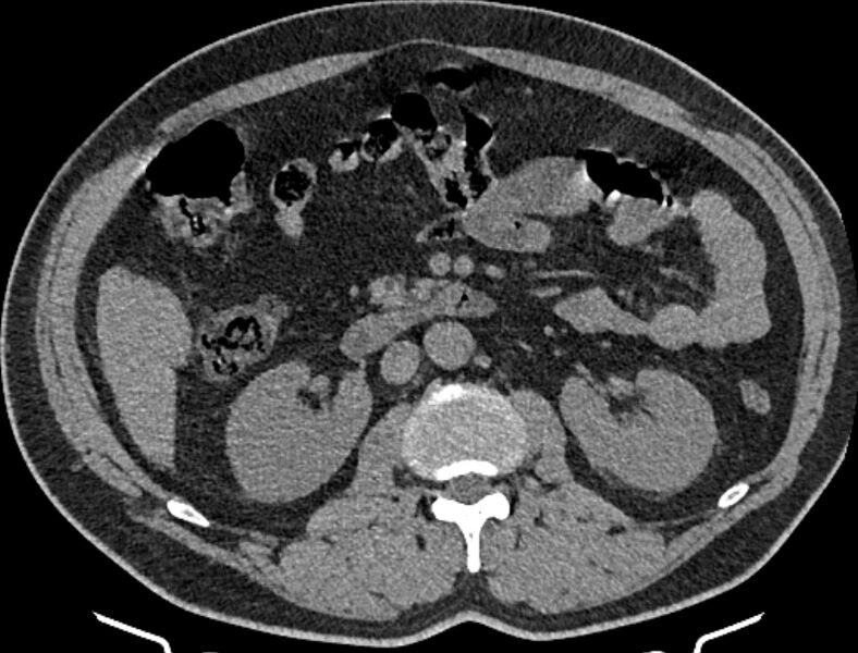 File:Cardiogenic pulmonary edema (Radiopaedia 68180-77678 Axial non-contrast 82).jpg