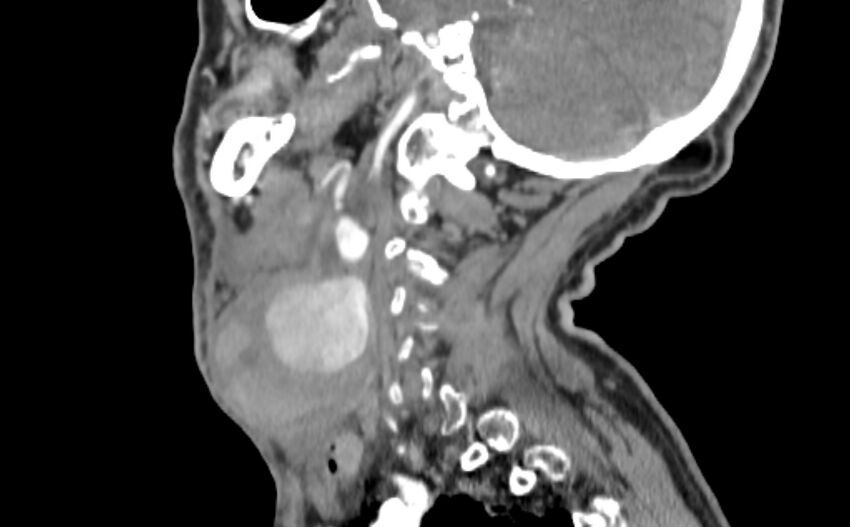 Carotid artery pseudoaneurysm (Radiopaedia 84030-99259 E 29).jpg