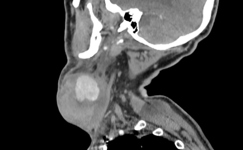 File:Carotid artery pseudoaneurysm (Radiopaedia 84030-99259 E 46).jpg