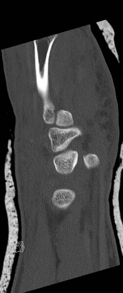 File:Carpal fractures (smart watch impaction) (Radiopaedia 55844-62430 Sagittal bone window 12).jpg